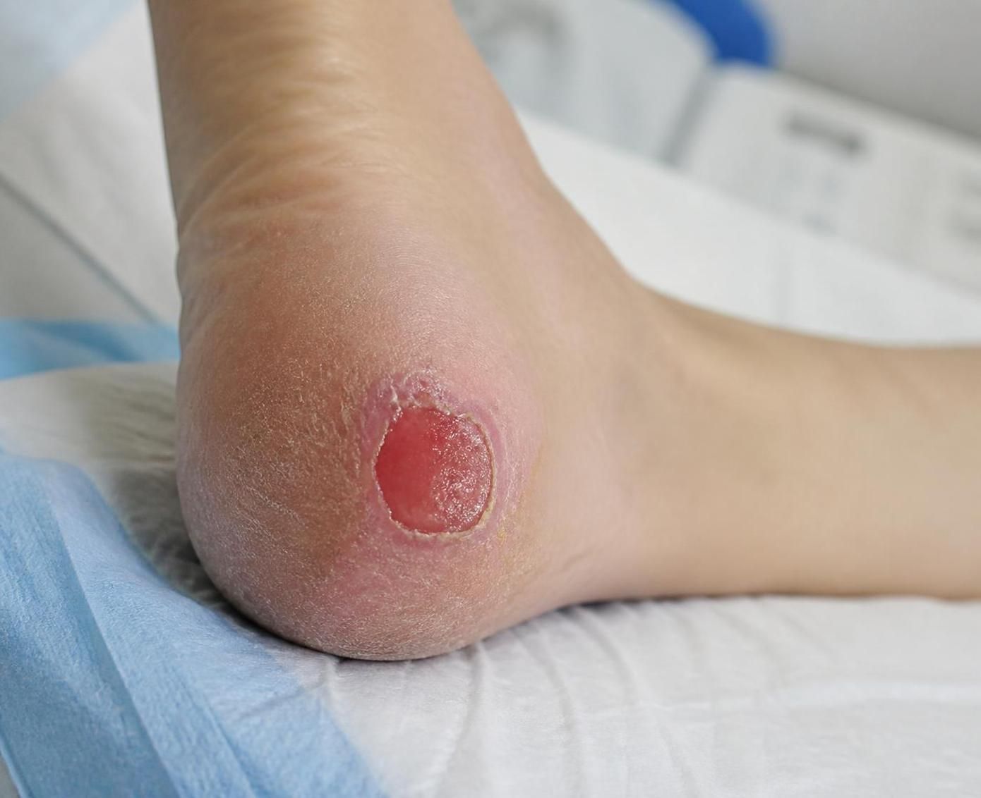 découvrez la durée moyenne de guérison d'une escarre et les méthodes efficaces pour accélérer la cicatrisation et prévenir les complications.