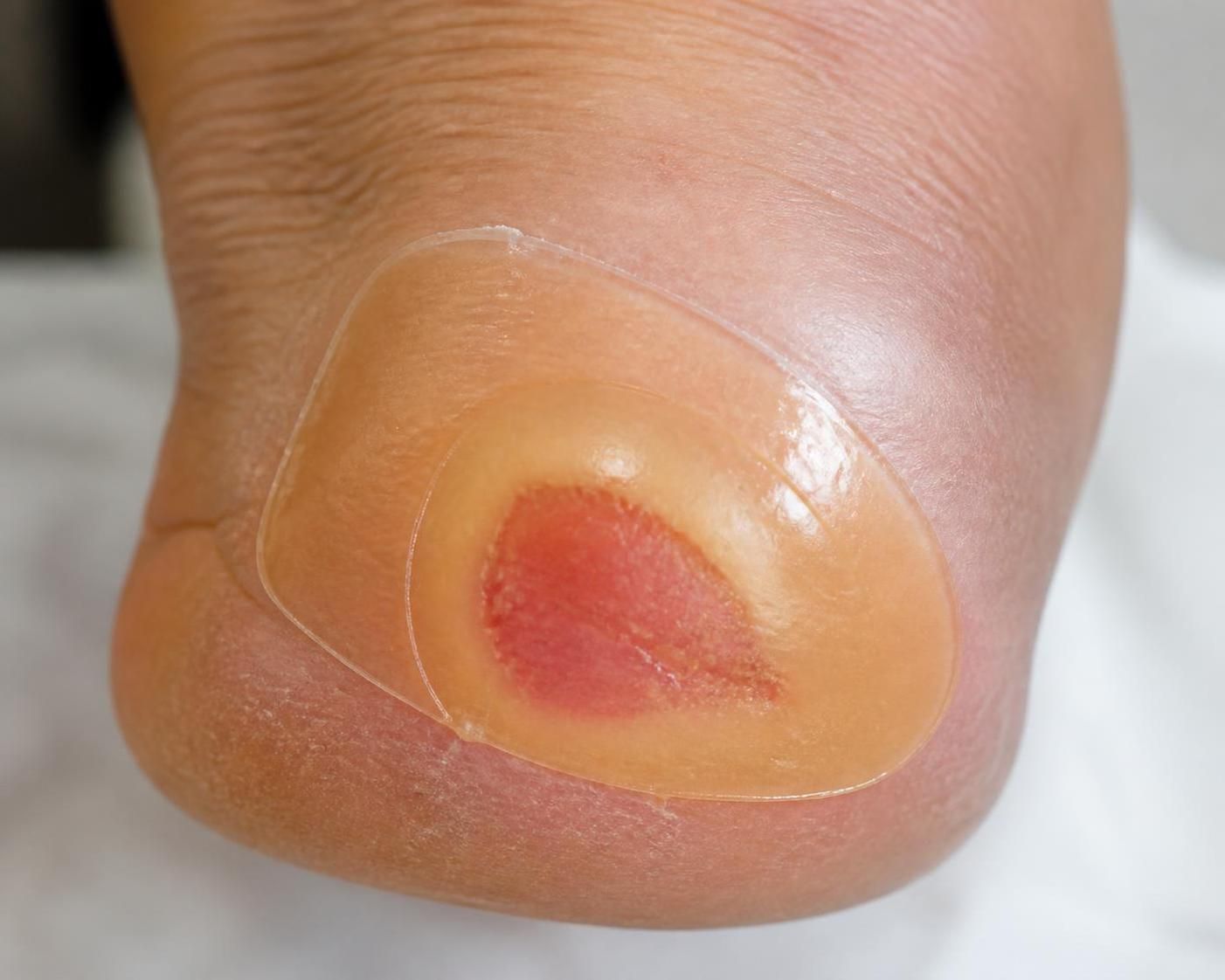 découvrez ce qu'est un pansement hydrocolloïde, ses avantages et apprenez à l'utiliser efficacement pour favoriser une cicatrisation optimale.