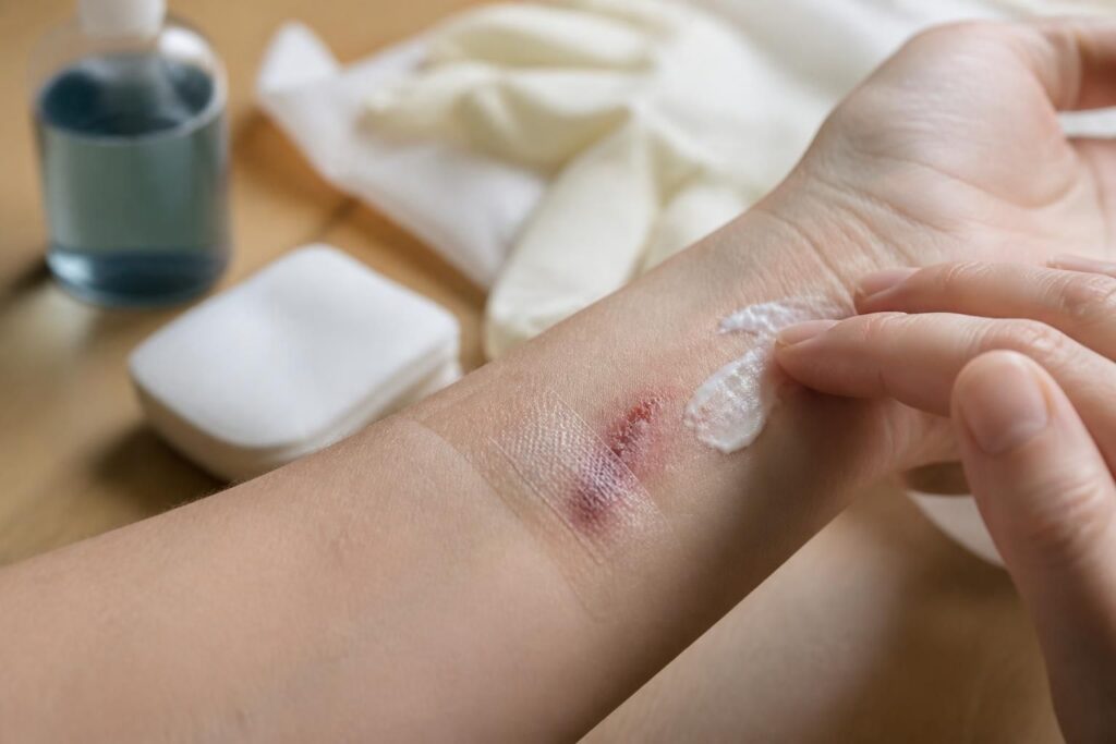 découvrez des méthodes efficaces et naturelles pour favoriser une cicatrisation rapide et optimale des plaies ouvertes, afin de prévenir les infections et accélérer la guérison.