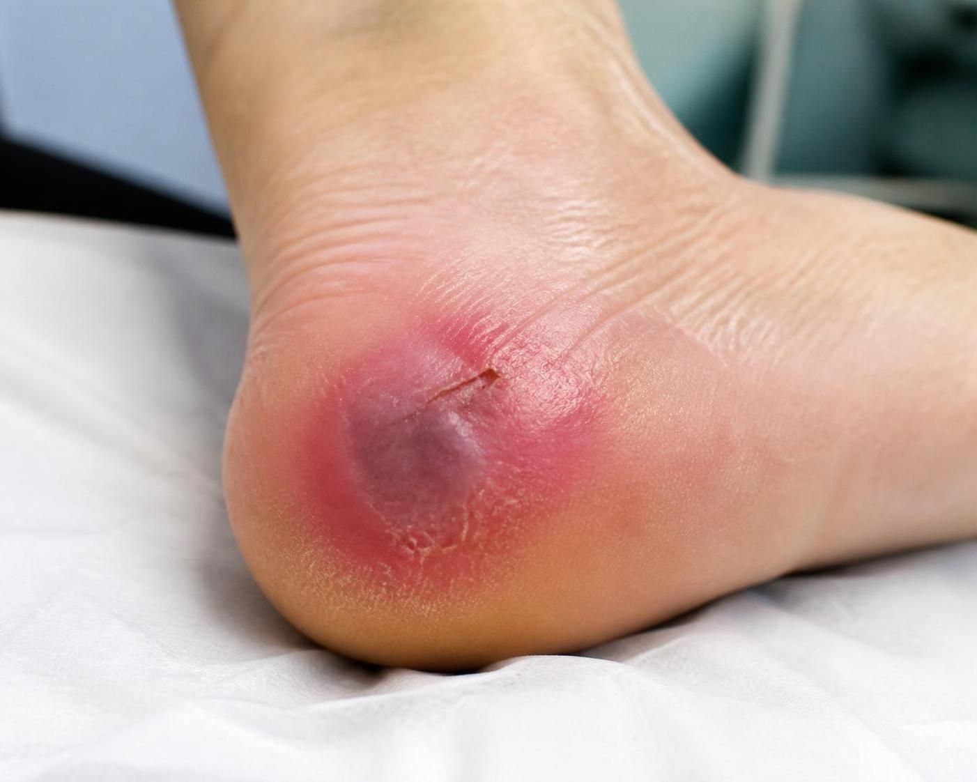 découvrez des conseils pratiques pour prévenir et soigner efficacement une escarre sur la jambe, afin de favoriser une guérison rapide et éviter les complications.