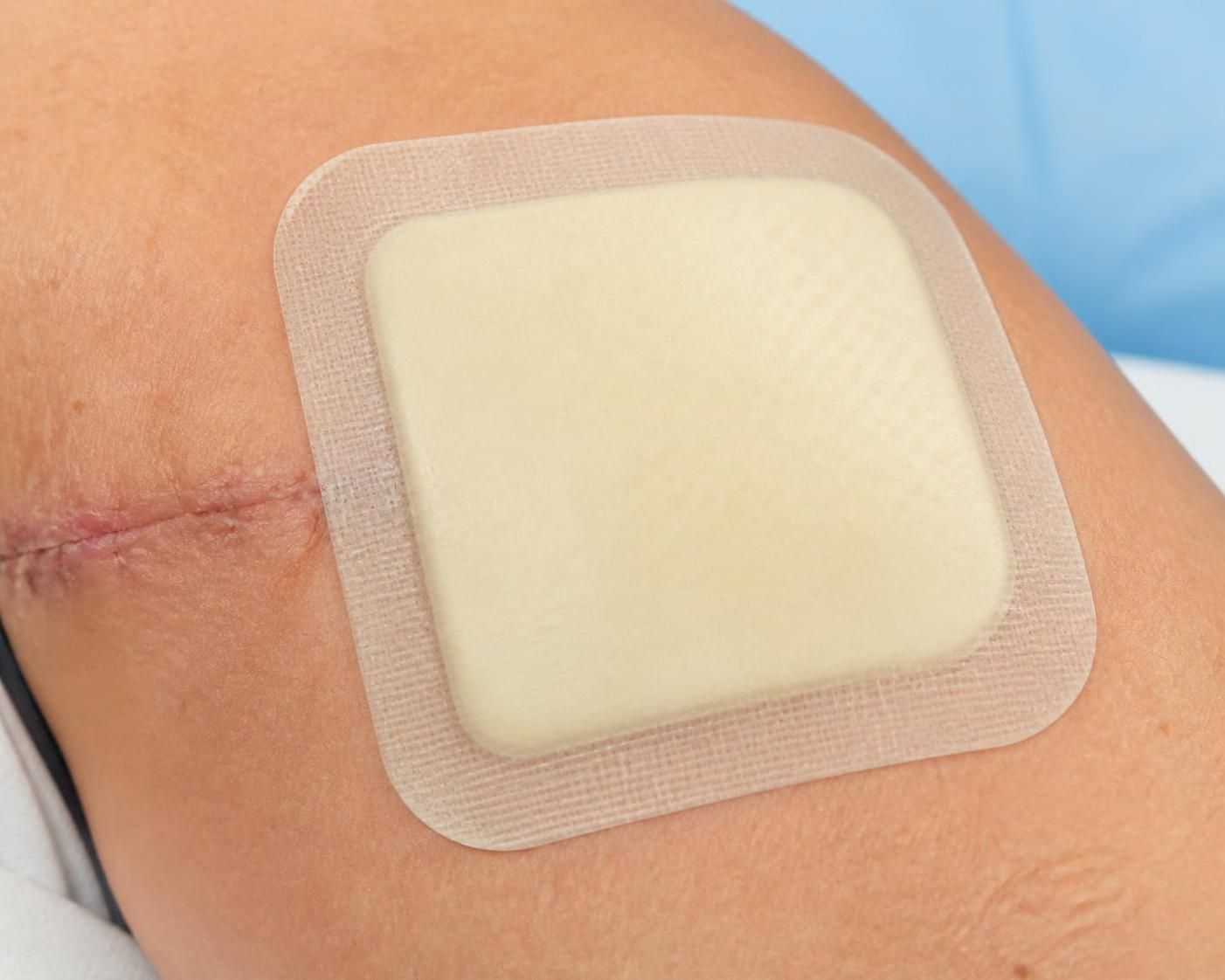 découvrez à quelles plaies s'adresse le pansement hydrocellulaire et apprenez à l'utiliser efficacement pour favoriser une cicatrisation optimale.