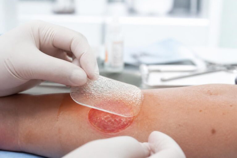 découvrez pour quelles plaies utiliser un pansement hydrocellulaire et apprenez à l'appliquer efficacement pour favoriser une cicatrisation optimale.