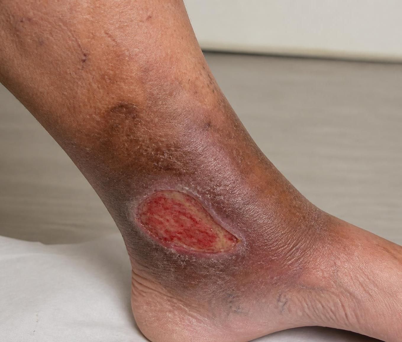 découvrez les causes courantes des ulcères à la jambe qui ne guérissent pas et les méthodes efficaces pour favoriser leur cicatrisation.