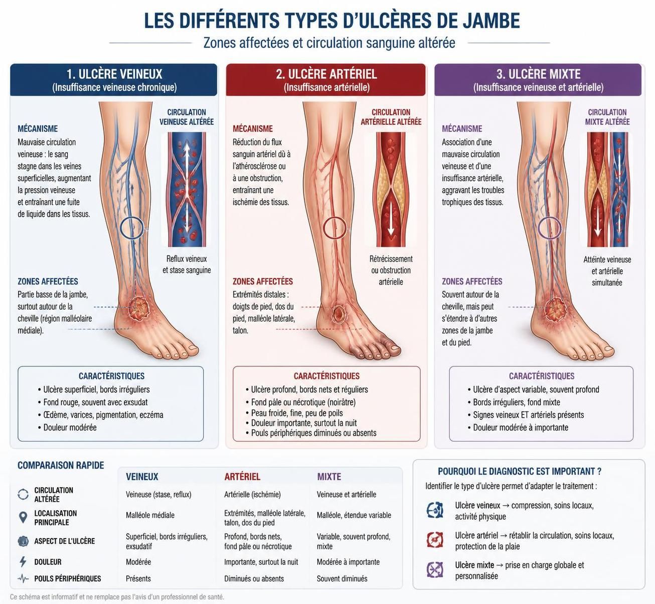 découvrez comment l'ulcère de jambe peut conduire à l'amputation, les facteurs de risque associés, et les options de traitement disponibles pour prévenir cette complication.