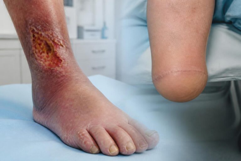 découvrez le lien entre l'ulcère de jambe et l'amputation, ainsi que les options de traitement disponibles pour prévenir les complications et améliorer la guérison.